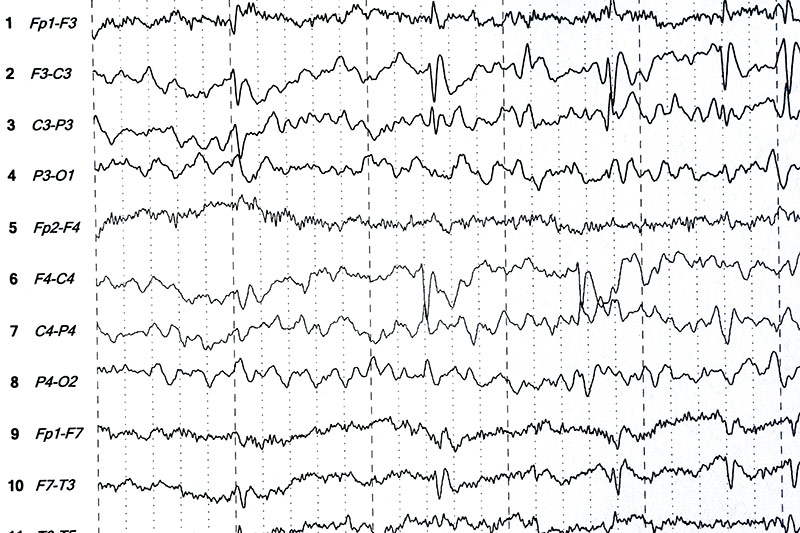 Diagnose in der Neurologie im Kreis Calw